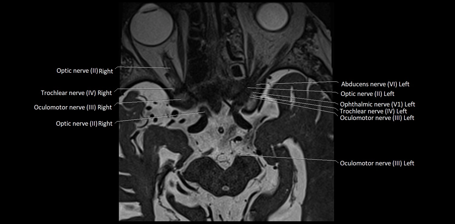 Cranial nerve anatomy axial MRI 3T image 15.webp